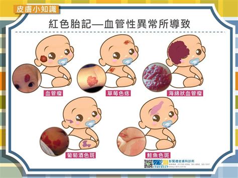 胎記位置|認識胎記的種類與治療照顧